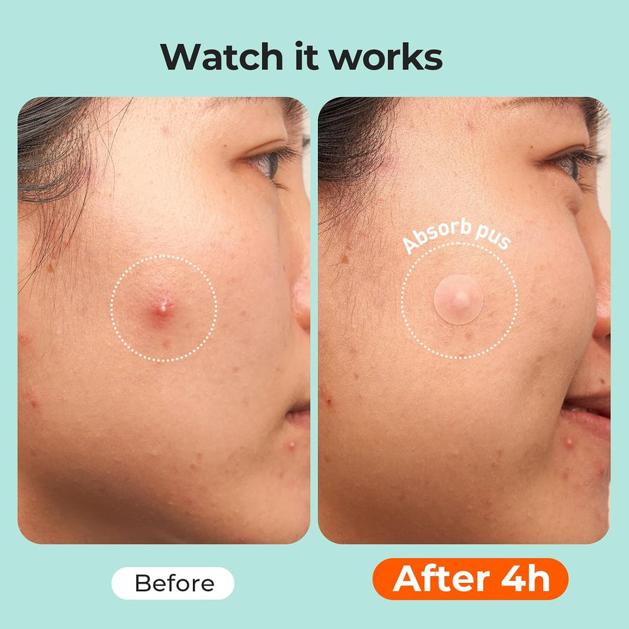 hazina store Acne Patches for Convenient Everyday Skincare